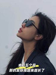 -碧莲盛·不剃发植发