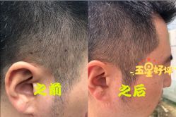 -爱莎扁平疣·汗管瘤·斑痣中心