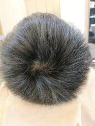 -大麦微针植发丨全国连锁