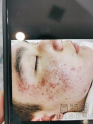 体验前-蕾特恩专业祛痘·皮肤管理