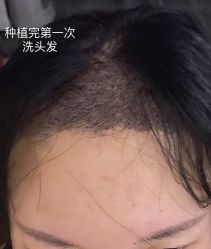 点击看大图 体验后-大麦微针植发全国连锁