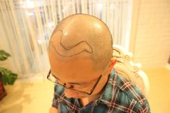 点击看大图 -大麦微针植发丨全国连锁