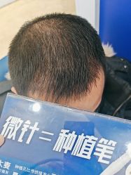 体验后-大麦微针植发全国连锁