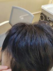 点击看大图 -碧莲盛·不剃发植发
