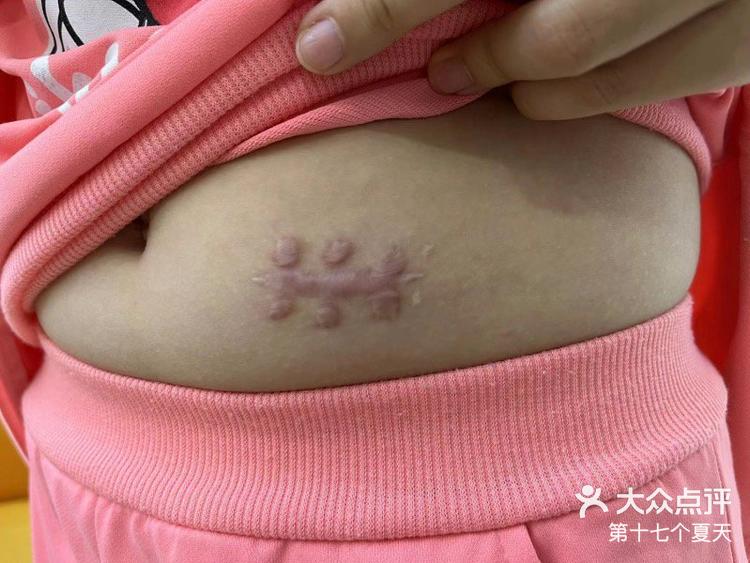 疤痕体质,肚子瘢痕疙瘩