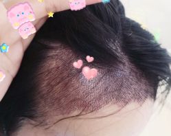 -大麦微针植发全国连锁