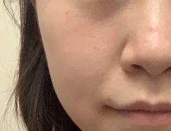 体验前-东莞缔美美容医院