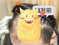 -大麦微针植发全国连锁