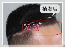 -大麦微针植发全国连锁