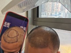 -碧莲盛·不剃发植发