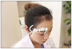 -大麦微针植发全国连锁