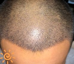 -大麦微针植发丨全国连锁