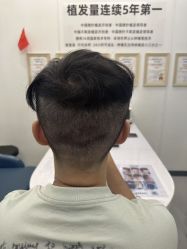-大麦微针植发全国连锁