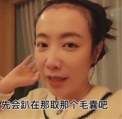 -碧莲盛·不剃发植发