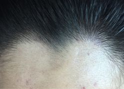 刚做完发际线-平萍纹绣韩式半永久定妆