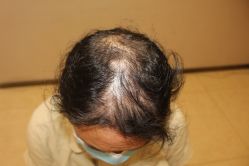 -大麦微针植发丨全国连锁