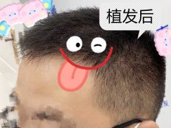 -大麦微针植发全国连锁