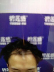 -碧莲盛·不剃发植发