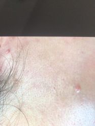 体验前-爱莎扁平疣·汗管瘤·斑痣中心