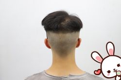 -大麦微针植发丨全国连锁