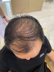 点击看大图 体验前-大麦微针植发丨全国连锁