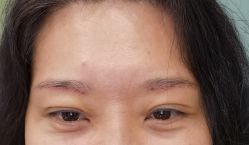 体验后-紫洁俪方（北京）医疗美容