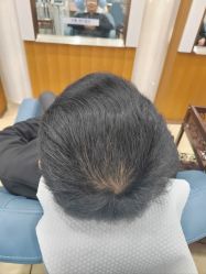 -大麦微针植发全国连锁