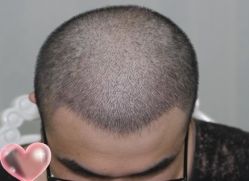 -大麦微针植发丨全国连锁