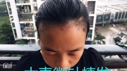 点击看大图 -大麦微针植发丨全国连锁