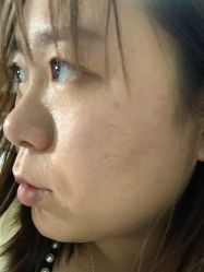 体验前-亿美医疗美容·半岛大超炮官方授权店