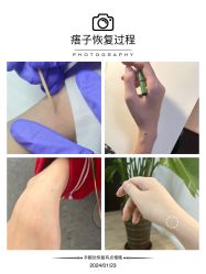 -清疣美疣·痣·斑净肤中心