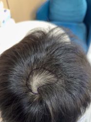 点击看大图 -碧莲盛不剃发植发