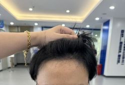 -大麦微针植发全国连锁