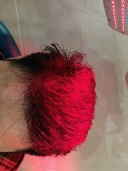 -碧莲盛·不剃发植发