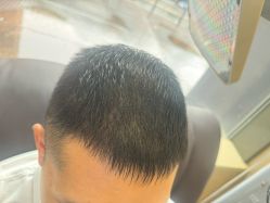 -碧莲盛·不剃发植发