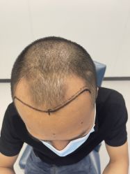 点击看大图 体验前-大麦微针植发全国连锁