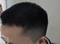 -大麦微针植发丨全国连锁