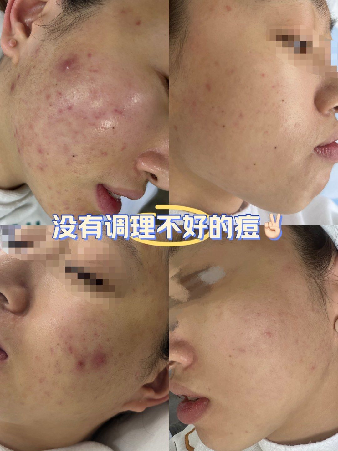 炎症痘痘效果对比图