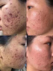-美丽人生祛斑扁平疣汗管瘤中心