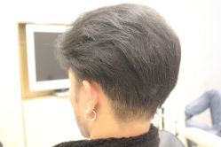 点击看大图 -大麦微针植发丨全国连锁