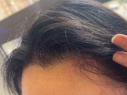 -碧莲盛·不剃发植发