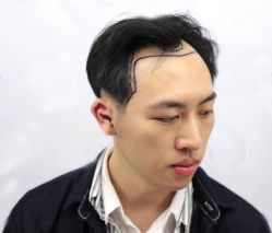 -大麦微针植发丨全国连锁