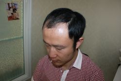 -大麦微针植发丨全国连锁