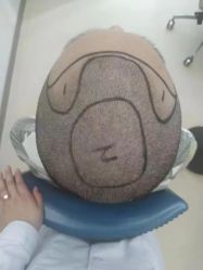 -大麦微针植发丨全国连锁