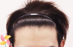 -大麦微针植发丨全国连锁