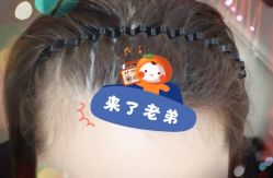 -大麦微针植发全国连锁