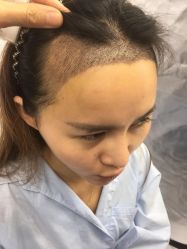 -大麦微针植发丨全国连锁