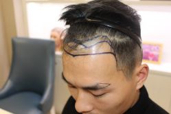 -大麦微针植发丨全国连锁