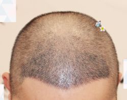 -大麦微针植发全国连锁