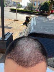 -大麦微针植发全国连锁